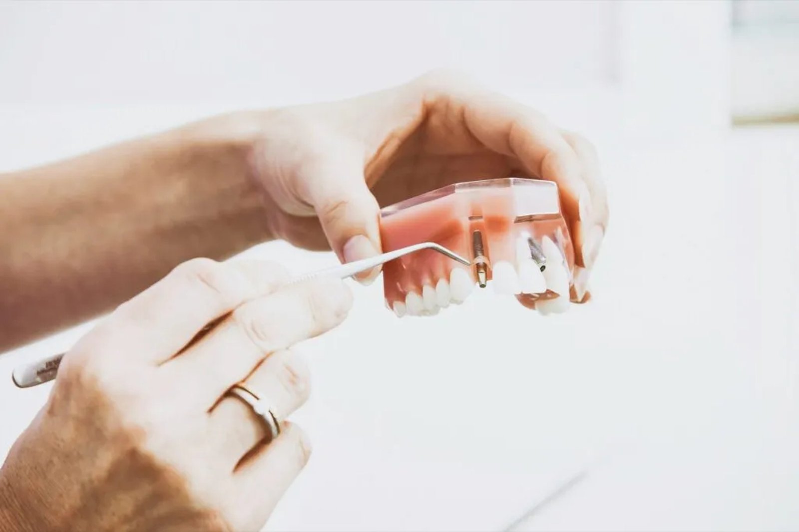 Zahnarzt erklärt einem Patienten ein Implantat-Modell